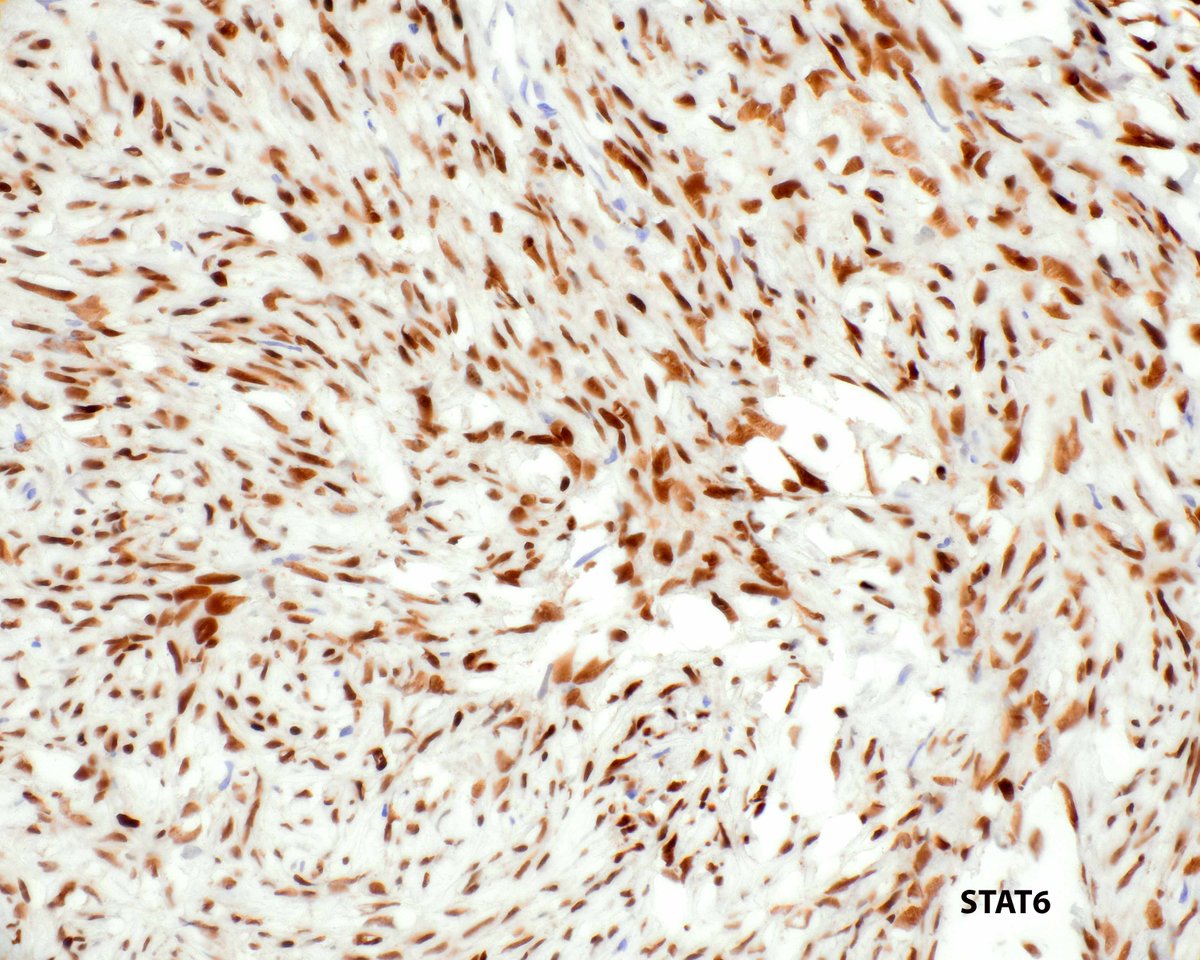 An unusual case - sclerosed solitary fibrous tumor forming a large bladder mass. An uncommon tumor in a rare site. #UMiamiPath