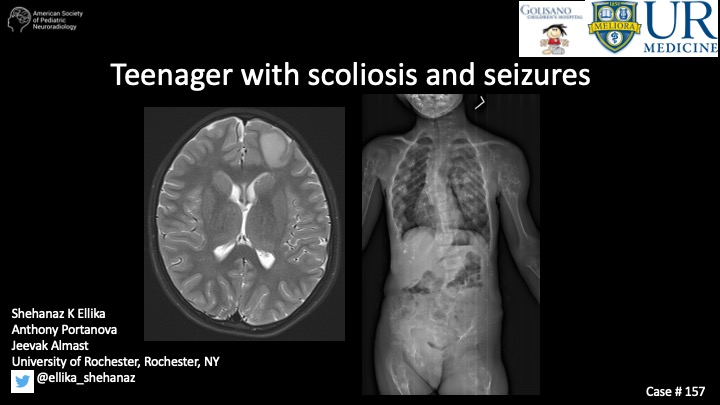 American Society of Pediatric Neuroradiology (@the_aspnr) on Twitter photo Case of the week: Teenager with scoliosis and seizures
Thank you, Shehanaz K Ellika, Anthony Portanova,
and Jeevak Almast; University of Rochester, for sharing this case. <a href="/ellika_shehanaz/">Shehanaz Ellika</a> #PediNeuroRad #MedEd #FOAMrad #PedsRad #NeuroRad
full case: aspnr.org/learning/cases⦠Case of the week: Teenager with scoliosis and seizures
Thank you, Shehanaz K Ellika, Anthony Portanova,
and Jeevak Almast; University of Rochester, for sharing this case. <a href="/ellika_shehanaz/">Shehanaz Ellika</a> #PediNeuroRad #MedEd #FOAMrad #PedsRad #NeuroRad
full case: aspnr.org/learning/casesā¦