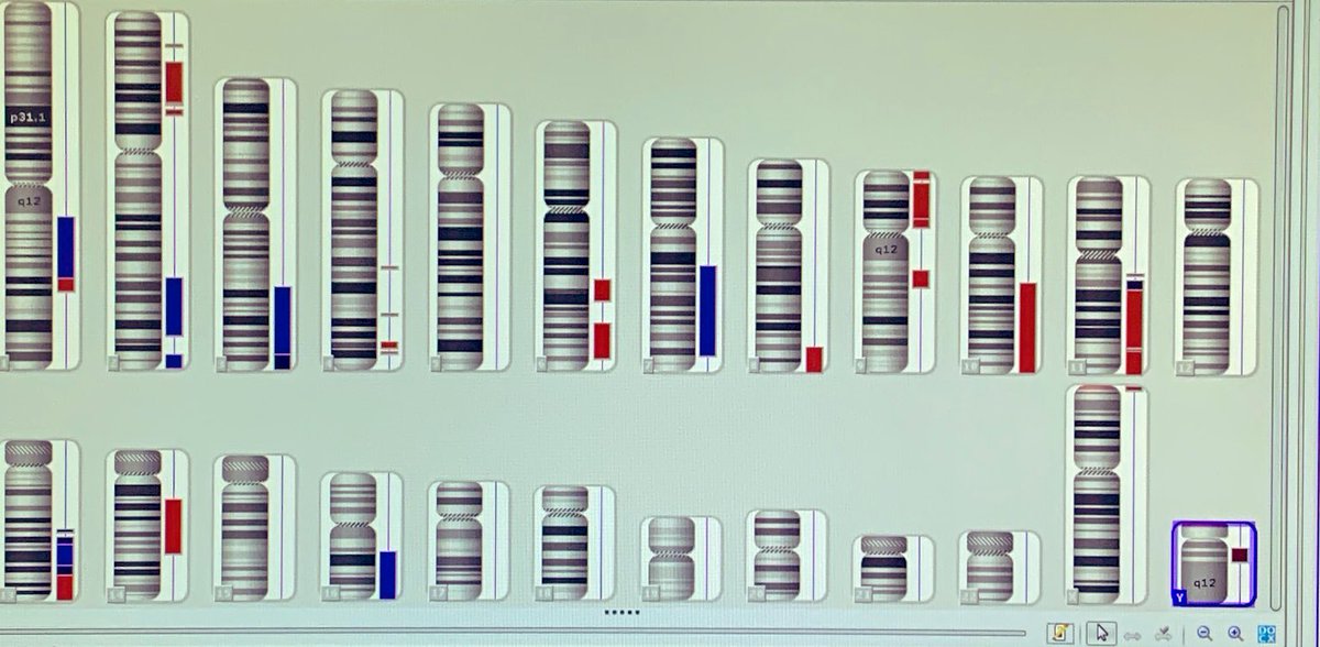 marta_msalido's tweet photo. Genetic complexity of a diffuse large B-cell lymphoma case detected by SNP-array. FISH detected variant pattern with 3’MYC probe deletion confirmed by arrays🥂#variantFISHpatterns #lymphoma #FISHPower https://t.co/NzWOwcX8Hq