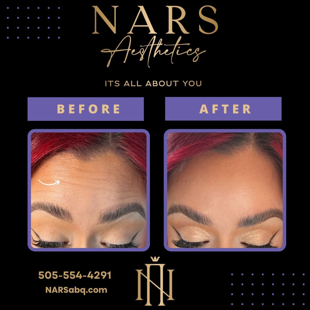 narsabq's tweet photo. Celebrating the amazing transformation that #Beauty-TOX can achieve! 🤩 From wrinkles to radiant, youthful #skin - amazing! 💖 #BotoxJourney #SmoothSkin #FreshLook 🤩 #botox #xeomin #dysport #beauty #fillers #skincare #filler #juvederm #antiaging #lips #aesthetics #lipfiller  ... https://t.co/b6yzqAXj7o