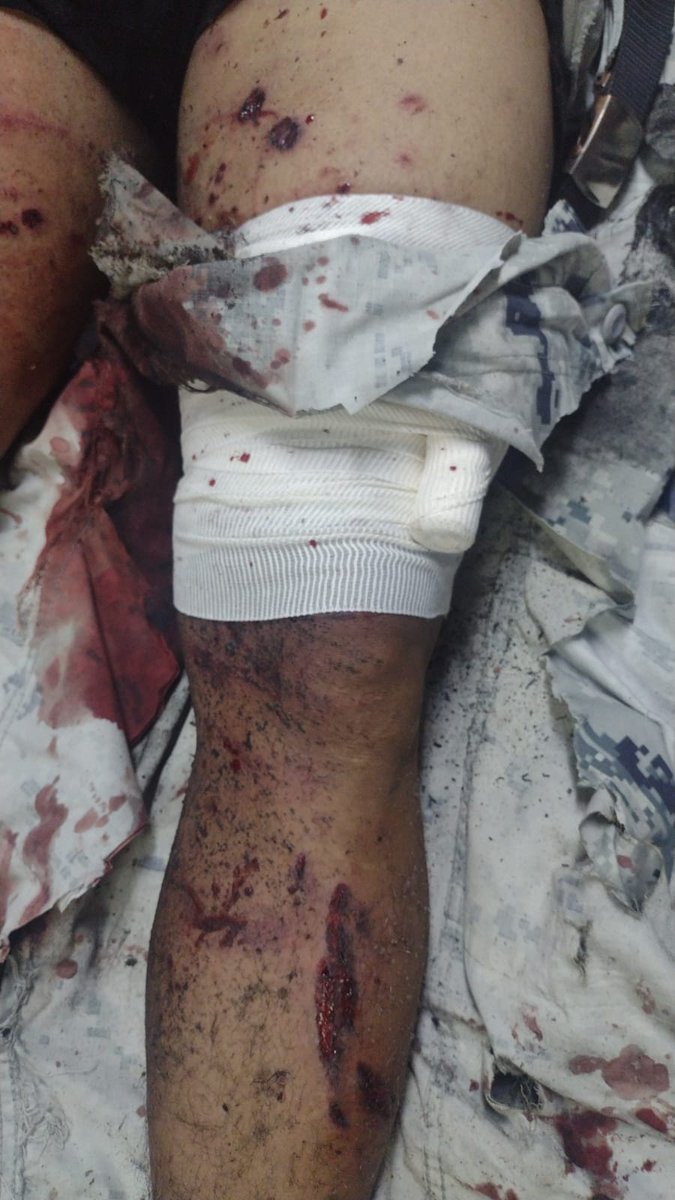 #Celaya #CocheBomba actualización dos elementos de la Guardia Nacional heridos graves, uno con amputación de brazo derecho y otro con quemaduras y daños en tímpanos, 8 solo tenían heridas leves