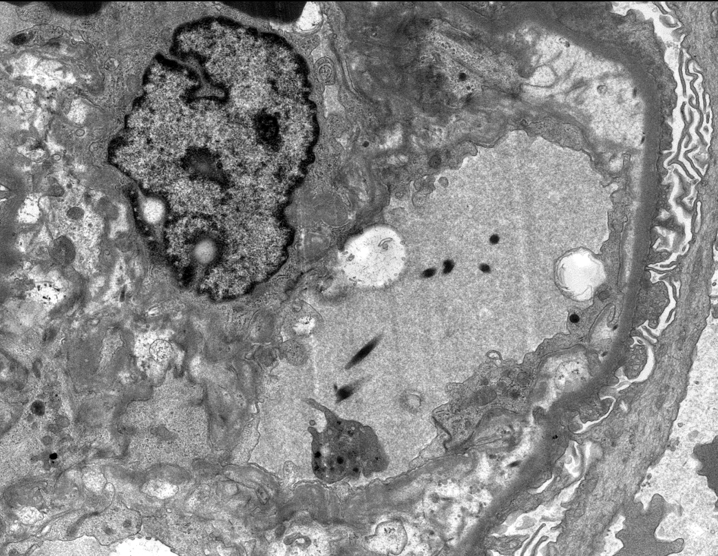 JZRenalPath's tweet photo. Interesting #onconephrology case of doxil induced microangiopathy in a patient biopsied for heavy proteinuria.  Prominent mesangiolysis and double contours. Only rarely ever previously reported (PMID: 35509676). #renalpath #pathtwitter https://t.co/6M5AdzHXSj