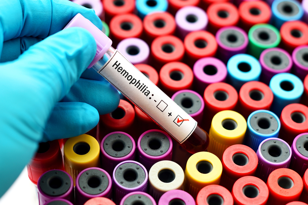 isfmcmx's tweet photo. 📢La hemofilia B, es un trastorno genético causado por la falta o defecto del factor IX, una proteína de coagulación. Aunque se transmite de padres a hijos, alrededor de 1/3 de los casos son causados por una mutación espontánea, un cambio en un gen.
#ISFMC #SaludFuncional https://t.co/1nWOtpNVS0