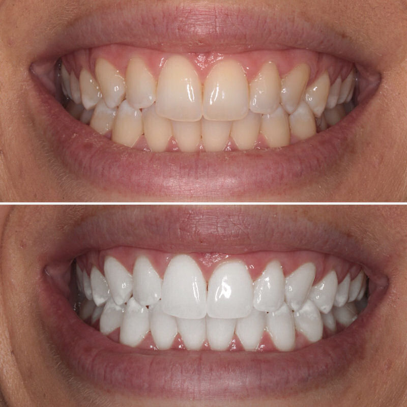 CarbamideTeeth's tweet photo. You wont believe the before and after results from using our professional teeth whitening kit!   #teethwhitening https://t.co/duzi7kpWHk