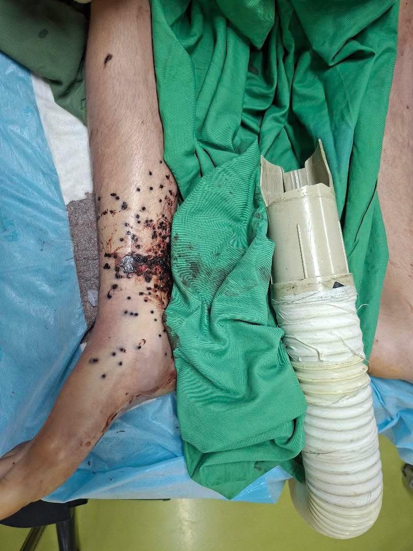 Vahid's tweet photo. ⚠️Heart-wrenching and bloody images of people injured in #IranProtests
Received from ‘a hospital in #Isfahan #Iran’ https://t.co/3fLZ3gLQ7J