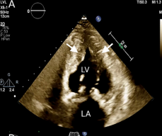AppCardioNova's tweet photo. 📋Apical Hypertrophic Cardiomyopathy: A Clinical & Multimodality Imaging Assessment 👇🏼
🔗DOI: 10.1111/echo.70235
#Review #POCUS #Whycmr #apical #ECG https://t.co/cjSFP5j8Ta
