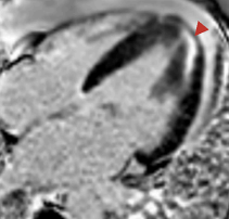 AppCardioNova's tweet photo. 📋Apical Hypertrophic Cardiomyopathy: A Clinical & Multimodality Imaging Assessment 👇🏼
🔗DOI: 10.1111/echo.70235
#Review #POCUS #Whycmr #apical #ECG https://t.co/cjSFP5j8Ta