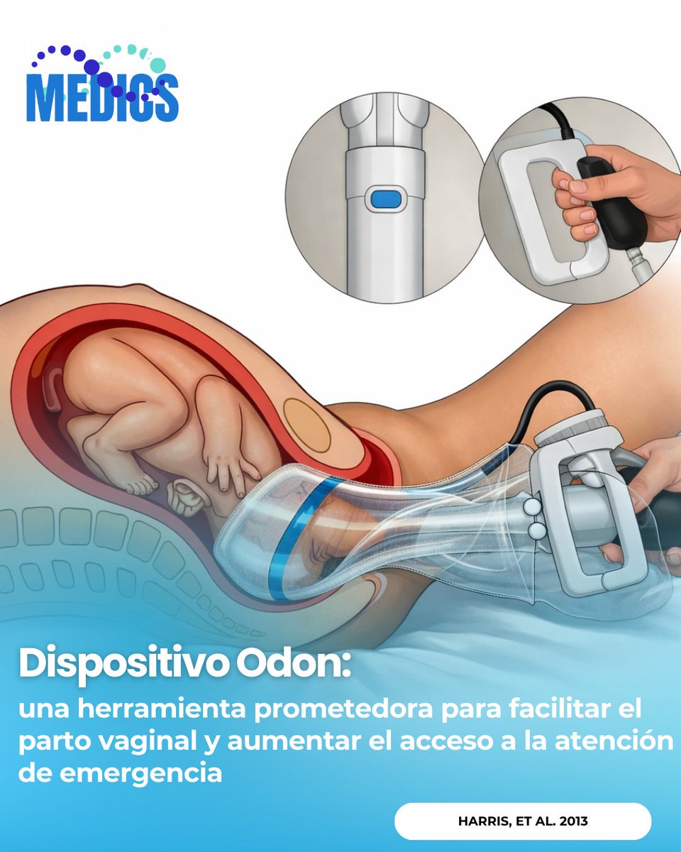 Metamedicsmx's tweet image. El dispositivo Odon propone una alternativa de bajo costo y potencialmente más simple para partos vaginales asistidos. La OMS planteó un protocolo en 3 fases (Argentina y Sudáfrica) para evaluar factibilidad/seguridad antes de afirmar eficacia. Fuente: DOI 10.1186/1742-4755-10-42