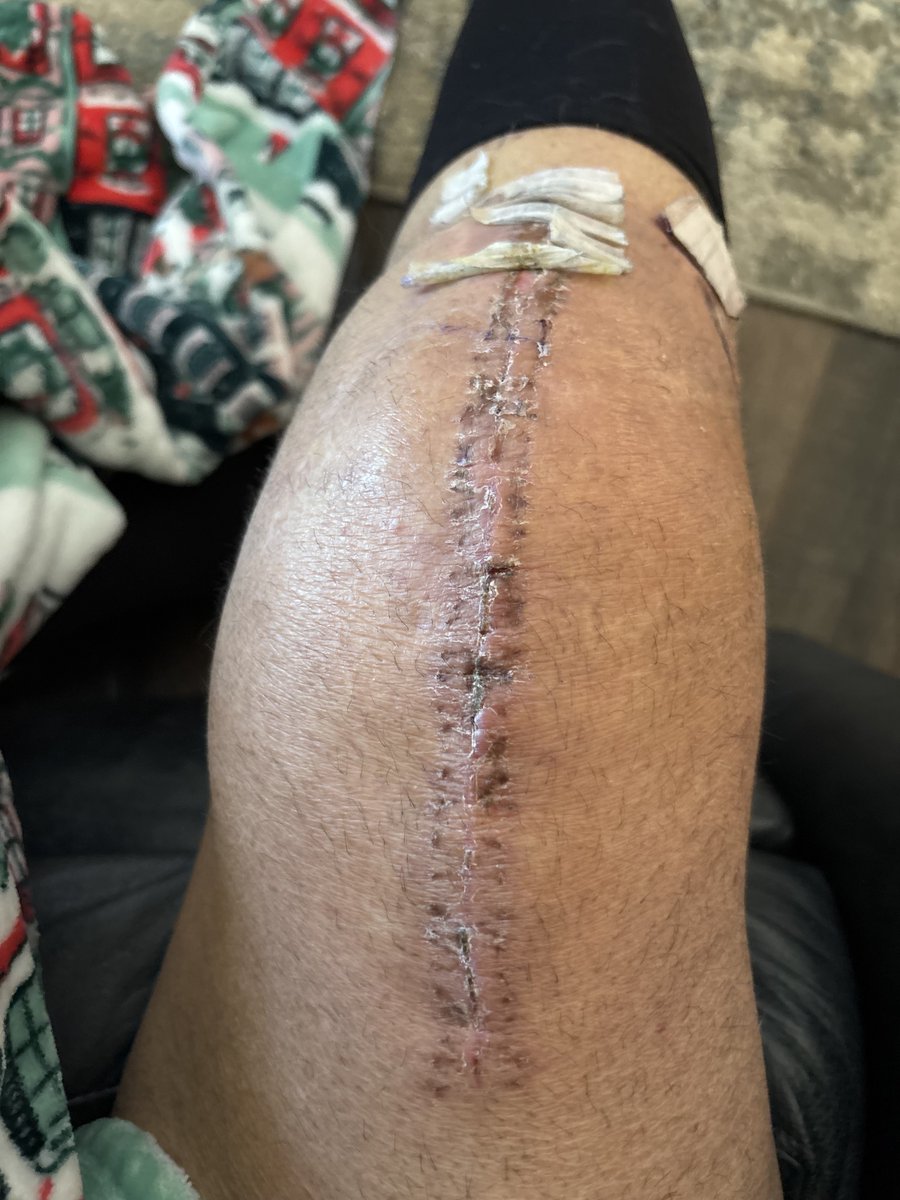 fisher_vern's tweet photo. 5 weeks out from surgery. Have come a long way, getting stronger everyday! T has been wonderful taking care of me and makes sure I do the right things. #bionicman https://t.co/Lo7Uc0Wb9w