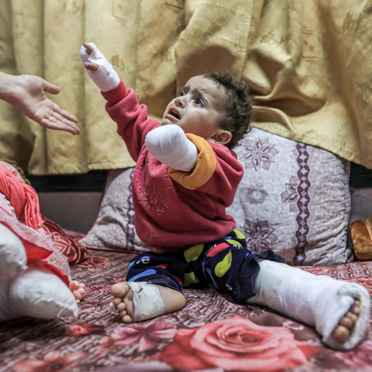 Palestinedaily1's tweet image. Gaza has the most child amputees in the world — and in modern history