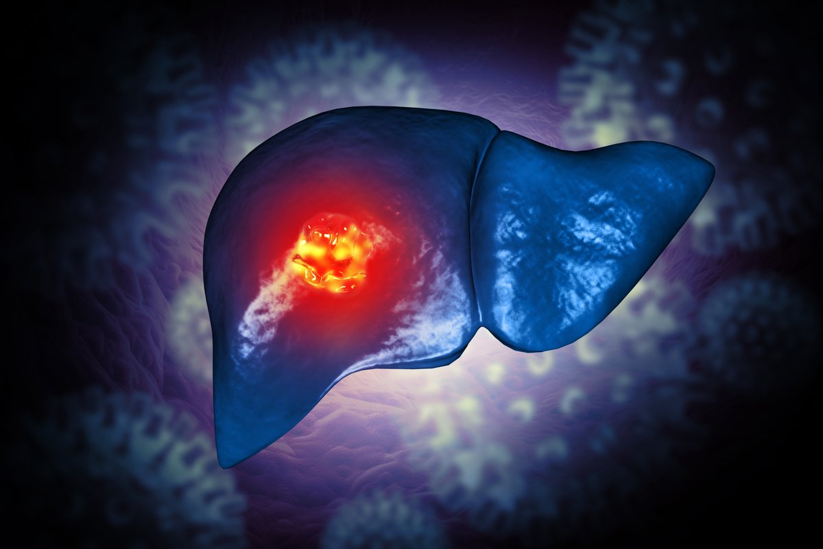 UTSWMedCenter's tweet photo. This week, @UTSWcancer became the first in Texas to offer Hepzato, a novel whole-liver chemotherapy that effectively treats liver metastases caused by uveal melanoma. It's the only FDA-approved treatment of its kind and has been proven to shrink tumors. https://t.co/ncC1m9FXW2 https://t.co/PQLPEo4Uer