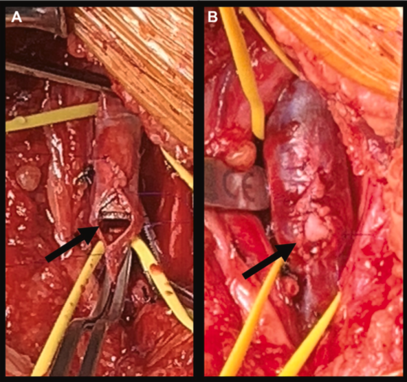 JVS - Venous and Lymphatic Disorders tweet media