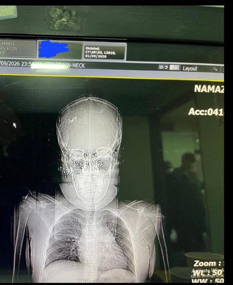 حرومزاده ها رو نگاه کنید، شلیک مستقیم ساچمه به صورت یک زن تو شیراز، هر دو چشم کور شده، بعد یک سری مادرجنده طرفدار جمهوری اسلامی دارن تو غرب عشق و حال میکنند
این کم کاری ماست که به اینجا رسیده اوضاع
#IranMassacre