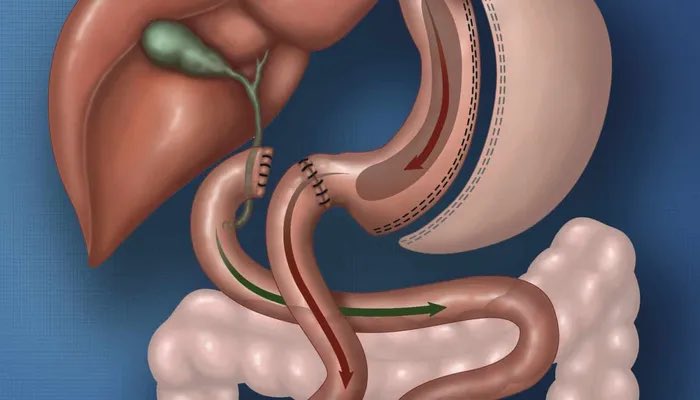 Duodenal Switch (SADI-S) hakkında bilmeniz gerekenler drmuratustun.com/obezite-cerrah…