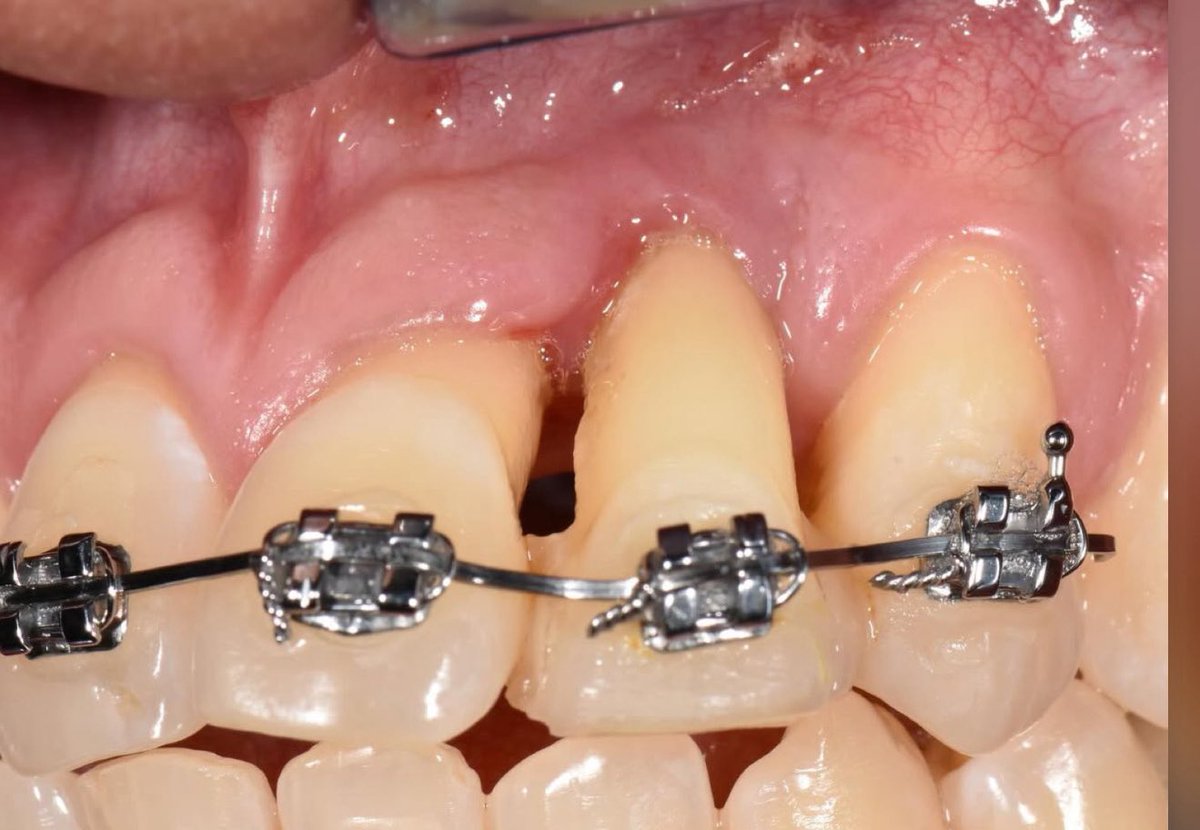 Ya no hagamos ortodoncia sin diagnóstico periodontal previo. 🙏🏼