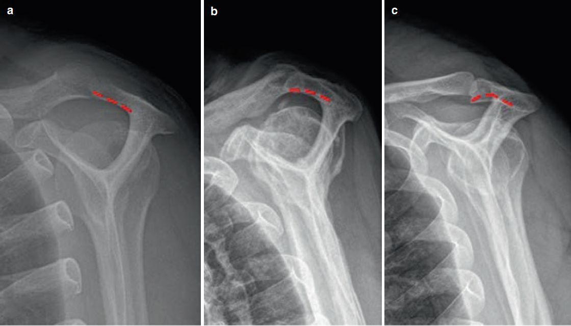 The three types of acromion according to the X-ray: (a) Type I: flat acromion. (b) Type II: Curved acromion. (c) Type III: hook-like acromion