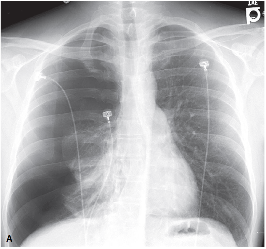 ManualOMedicine's tweet photo. 37 y/o man presents to the Emergency Department with pleuritic chest pain and shortness of breath.
- What’s the diagnosis ?

#medtwitter #foamed #foamrad https://t.co/aGe6Ix3Ew4