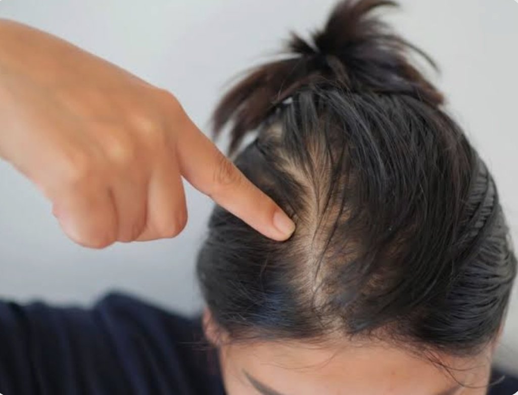 ayurbySree's tweet photo. Hair fall is not always “just shampoo problem” 🙌
In Ayurveda, hair fall is called Khalitya and it can happen due to body heat (Pitta), dryness (Vata), stress &amp; poor scalp health.
Ayurveda manages hair fall with oil massage, herbal paste, Nasya &amp; Dhara 🌿 https://t.co/Xr155hbwNc