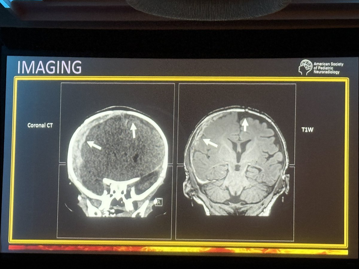 The_ASPNR's tweet image. Dr Rebekah Clarke from UT Southwestern heats it the rapid fire section with compelling cases of abusive head trauma 🔥#pedineurorad #ASPNR26 #pedsrad #radres #MedEd