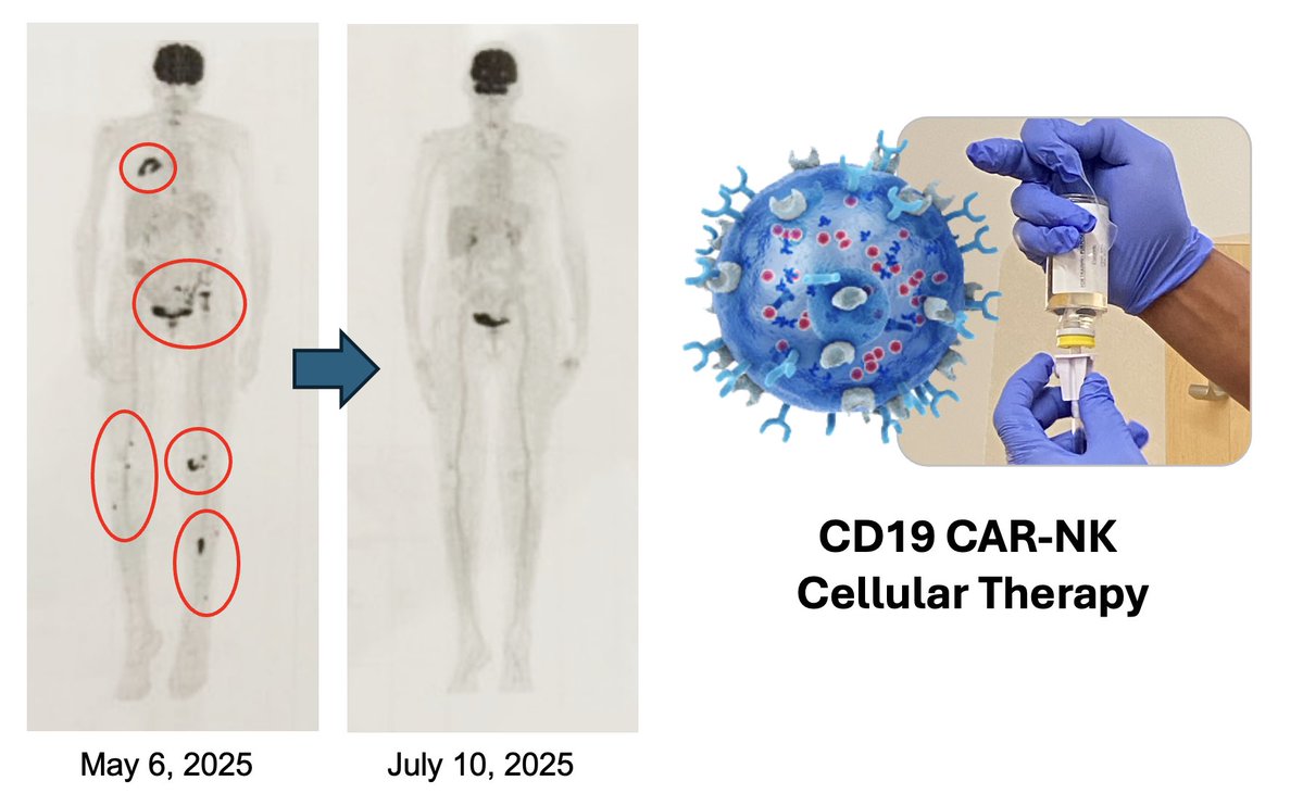 DrPatrick's tweet image. Seeing is believing. The patient with multiple bone tumors after failing standard of care and complete response after just 4 doses of our targeted NK cells. And now in ongoing remission 7 months with no further treatment. The power of NK cells is self evident. 

Outpatient…