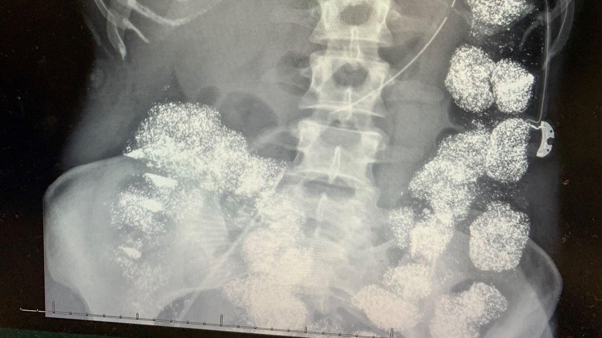 Kadeesayong's tweet image. ข่าวนี้โคตรน่ากลัวเลย ผู้หญิงคนนึงป่วยเรื้อรังหลายเดือนน้ำหลักลดฮวบ 20 โลคิดว่าตัวเองเป็นมะเร็งกระเพาะอาหาร จนวันนึงไม่ไหวไปรพแต่ยังไม่ถึงเตียงก็ชักหมดสติ หมอพบปริมาณตะกั่วจำนวนมากในร่างกาย โดยเฉพาะลำไส้เต็มไปด้วยตะกั่วเกือบ 100%
 
- ก่อนหน้านี้แข็งแรงดีแต่ 6…