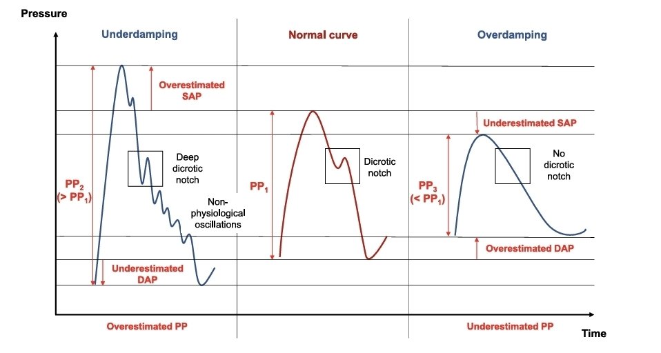 LeslieMegom's tweet photo. 🫀🧠🫁Fisiología aplicada a la cabecera del paciente: uso de la presión arterial invasiva como una verdadera herramienta de monitorización 🧐
📝Notas  y perlas 💎cafeteras ☕️ 
1️⃣📈La línea arterial no es un monitor de presión🔍: Es un monitor de fisiología
👀Si sólo miras la MAP, estás desperdiciando >70% de la información.‼️
💎  > Perla: una MAP “normal” puede coexistir con hipoperfusión severa si se sostiene a costa de vasoconstricción extrema o taquicardia.🫀
🔰Se propone dejar de ver la presión arterial invasiva (PAi) como un “número de seguridad” (p. ej., MAP ≥ 65 mmHg) y usar cada componente de la curva arterial presión arterial sistólica (SAP), Presión Arterial Diastólica, MAP y Presión de pulso como un monitor fisiológico dinámico para diagnosticar el fenotipo🤗 hemodinámico y ajustar 💧líquidos/vasopresores “en tiempo real”. ⏰️
🔍Reconocer artefactos clásicos:
⬇️🫀Underdamping → sobreestima SAP, subestima DAP, aumenta PP.
⬆️🫀Overdamping → subestima SAP, sobreestima DAP, “aplana” la curva.
💎Perla práctica: una decisión de líquidos,  escalamiento de vasopresores basada en una curva sobreamortiguada/subamortiguada es, literalmente, fisiología “sobre datos falsos”.
🔰A) MAP: presión de perfusión “macro”, pero no suficiente por sí sola
▶️MAP se mantiene como objetivo clínico sin embargo aislada  no identifica el mecanismo (↓CO vs vasoplejía) ni garantiza perfusión microcirculatoria. ‼️
🫀Subir PAM no siempre mejora perfusión si se hace sólo aumentando RVS.
🫀Una PAM “aceptable” puede ocultar: 
▪︎Bajo GC
▪︎Isquemia microcirculatoria
▪︎La línea arterial ayuda a inferir qué componente está fallando:
●DAP baja → RVS baja
●PP estrecha → GC bajo
●Perla de oro💎: antes de subir vasopresor, hay que preguntarse 🤔
👉 ¿la PAM está baja por bajo flujo o por bajo tono?🎯
🔰B) PAD presión arterial diastólica: el “termómetro” del tono vasomotor (y del tiempo diastólico)🫀
▪️ PAD  se interpreta como reflejo de tono arterial y con implicaciones directas para iniciar vasopresor temprano en vasoplejía. 
🔰La FC modifica PAD (diástole más corta puede elevar PAD aún con tono similar); por eso PAD aislada puede engañar si no se integra con FC. 🫀
🔰C) DSI (Diastolic Shock Index): HR/DAP para “detectar” vasoplejía grave y riesgo
🔶️DSI = FC / PAD se presenta como un marcador más robusto de tono vasomotor que PAD.🎯
☠️Se asocia con mortalidad y su desempeño se reporta comparable a SOFA/lactato y superior a MAP o “choque index sistólico”, además de identificar pacientes que se benefician de norepinefrina temprana. 💉
📝si PAD está baja y la FC alta (DSI alto), el fenotipo sugiere vasoplejía significativa → vasopresor TEMPRANO 💉
🔰VNERi: ▪️🫀Relación entre la presión arterial diastólica ajustada y la mortalidad en pacientes con choque  séptico.🧮
🫀▪️El choque séptico se asocia con la reducción del tono vasomotor y la hiporresponsividad a la norepinefrina .
🫀▪️VNERi puede guiar estrategias terapéuticas en casos de hipotensión persistente a pesar del tratamiento con NE.
🫀▪️VNERi mostró la asociación más fuerte con la mortalidad en comparación con otros índices.
♦️La Fórmula VNERi : (VNERi = TAD/(dosis NE x FC))
🔰La fórmula: TA Diastólica / (dosis de Norepinefrina x FC)
♦️Predice la mortalidad en pacientes con choque séptico un punto crítico en < 6.7.
🔰PP (Presión de pulso): Aproximación de volumen sistólico y herramienta para líquidos💧💧
●PP se discute como sustituto de volumen sistólico (SV) y como variable útil para “leer” la interacción corazón–arteria, con especial interés en reanimación del choque 🎯
●PP/PPV sólo son interpretables si: señal confiable, condiciones ventilatorias adecuadas, ritmo regular, sin gran esfuerzo inspiratorio espontáneo, etc.
●Cambios dinámicos (p. ej., durante elevación pasiva de piernas o maniobras ventilatorias) pueden ser más informativos que un valor aislado. animación fisiología-dirigida:
🎯MAP como objetivo macro de perfusión.👇🏽👇🏽