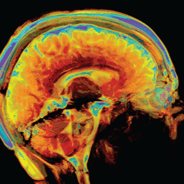 BrainandLifeMag's tweet image. What is a functional neurologic disorder, and what makes it different from other neurologic conditions? Our experts explain: hubs.la/Q03-RMNR0

#FND #FNDawareness