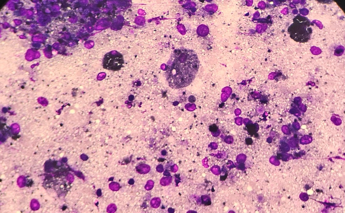 30/M FNAC Sternal lesion #cytopath ##pathtwitter #pathresidents <a href="/pepeheffernan/">Pepe Jiménez Heffernan</a> <a href="/vi_monappa/">Vidya Monappa</a> <a href="/DrGeeONE/">Olaleke Folaranmi</a> <a href="/kriyer68/">Kalyani Bambal</a>