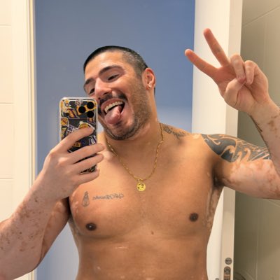 Diego Kydo 🐼 #vitiligo tweet media