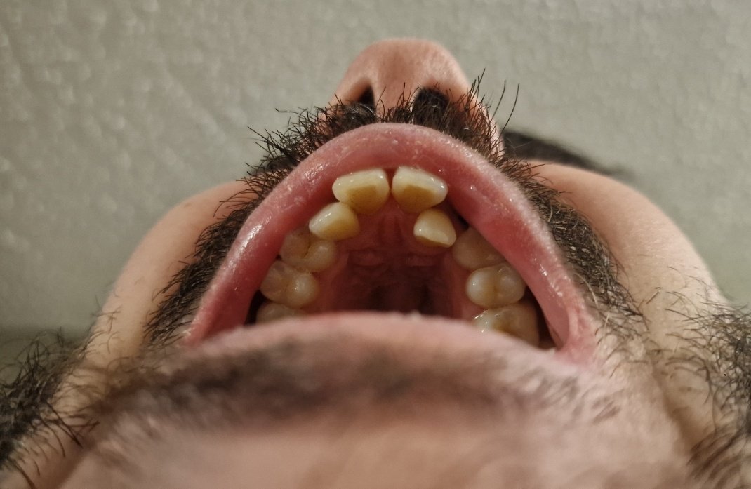 JPAFS's tweet image. En solo 8 semanas con brackets me ha cambiado la vida, puedo sonreir libremente por primera vez en mi vida adulta, mi mayor arrepentimiento hasta ahora es haber esperado tanto para empezar a arreglarme el alien vs predator que tenia en la boca.

(Si creen que esta foto de antes…