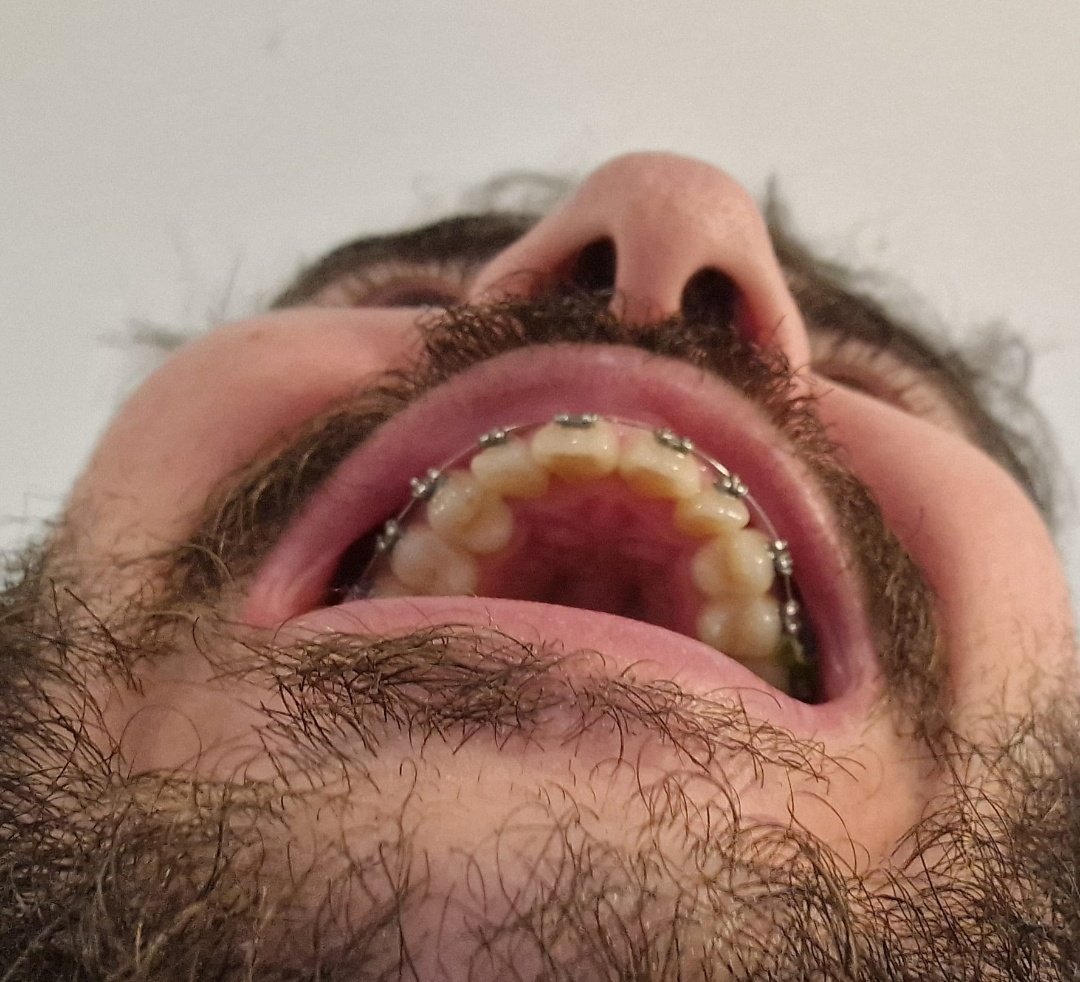 JPAFS's tweet image. En solo 8 semanas con brackets me ha cambiado la vida, puedo sonreir libremente por primera vez en mi vida adulta, mi mayor arrepentimiento hasta ahora es haber esperado tanto para empezar a arreglarme el alien vs predator que tenia en la boca.

(Si creen que esta foto de antes…