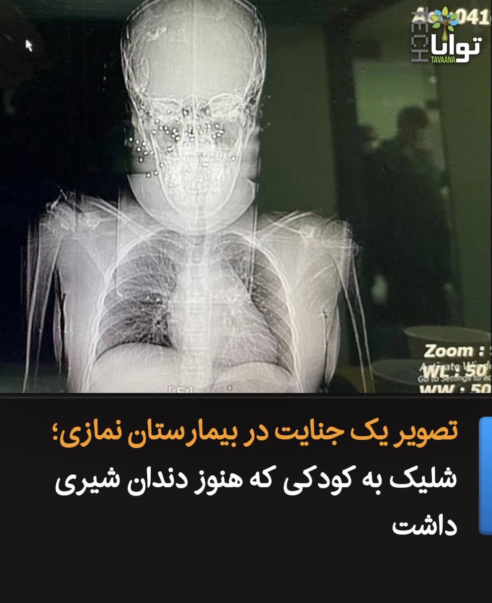 Mia_milovich24's tweet image. Mr. President Trump, this may be hard for you to believe, but this photo shows the skull of a 10-year-old Iranian girl who still had her baby teeth. She was shot in the face. 😭
I beg you, please help Iran😭
@realDonaldTrump 
#IranMassacre 
#IranMassacare 
#IranRevolution2026