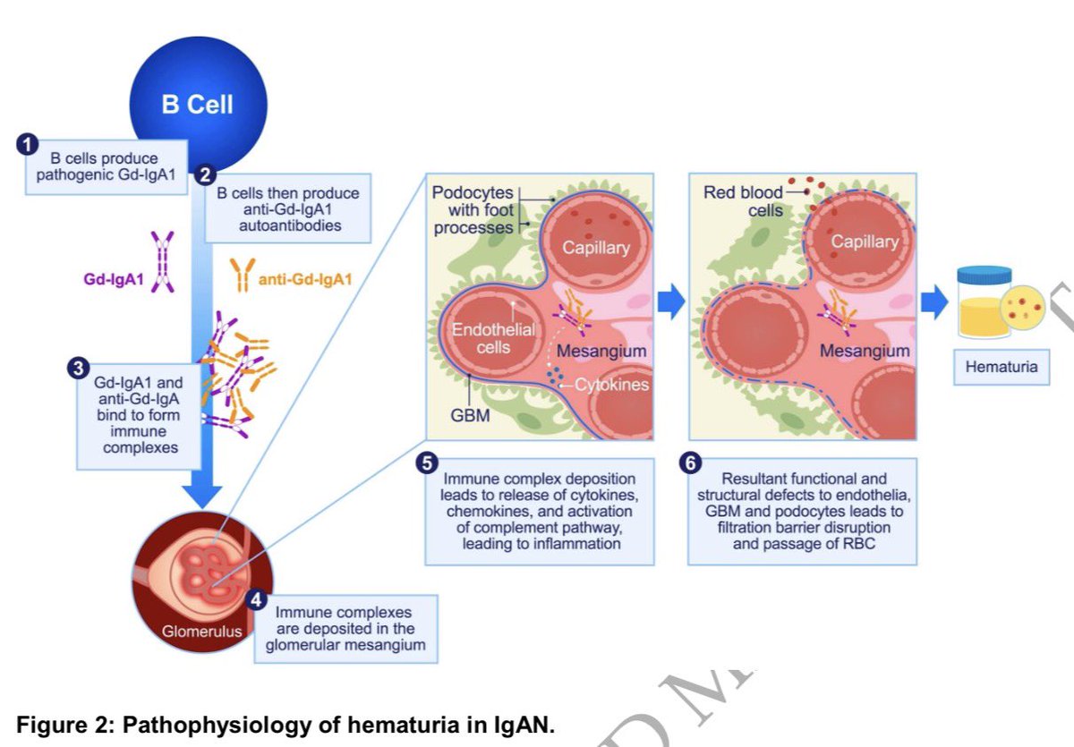 La hematuria🩸, aunque sea microscópica, también es nefrotóxica

Cuando los eritrocitos cruzan la barrera glomerular, ya en el túbulo se destruyen, exponiendo la hemoglobina y los productos hem, generando estrés oxidativo, inflamación y fibrosis

CKJ 2026
academic.oup.com/ckj/advance-ar…