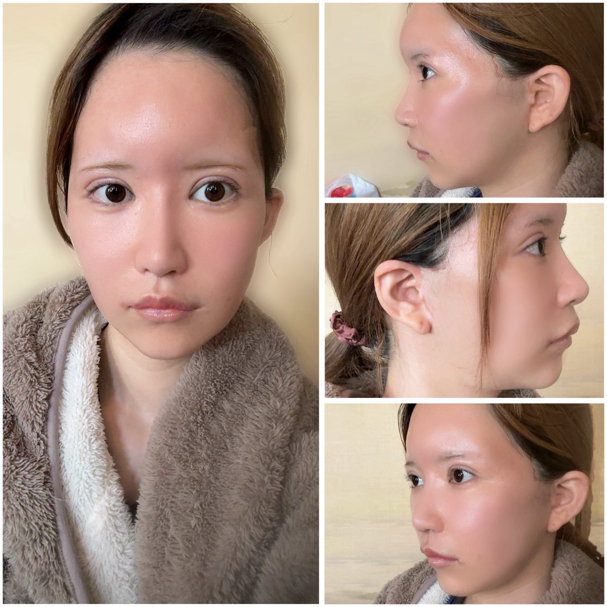 うる@切開リフトDT tweet media