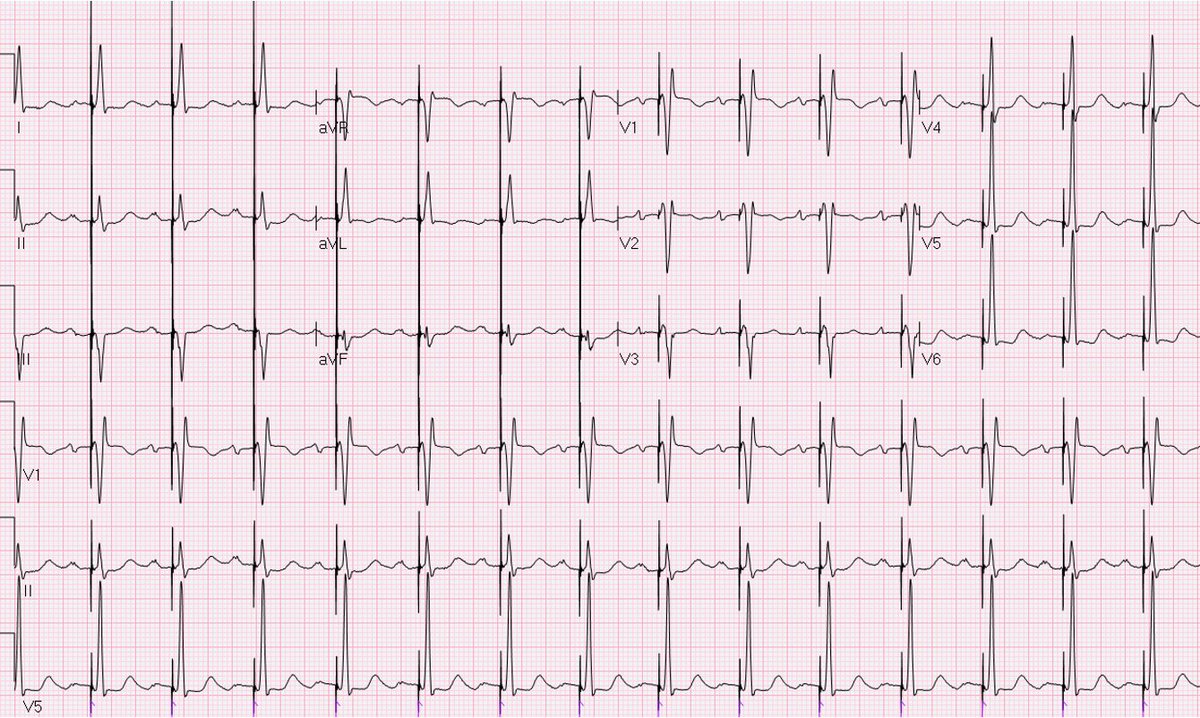 Dr_JozaEP's tweet image. First in the world to use the C320LBB Delivery sheath for LBBP. Thank you to @Medtronic for making it possible. A new tool for conduction system pacing. #LBBP #Epeeps Incredible day in the lab with @Hisdoc1 @efraim_roi and EP friends from South Korea. @KennethEllenbo1