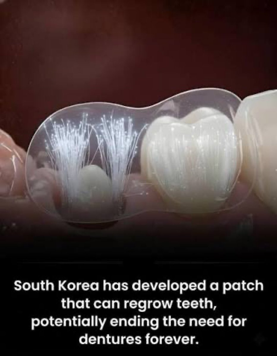AnayezaKha78911's tweet image. South Korean researchers have developed a biodegradable patch or gel that can stimulate teeth to naturally regenerate dentin—the hard layer beneath enamel. After the dentist cleans the cavity, the patch is placed directly onto the tooth. Its bioactive molecules, including…