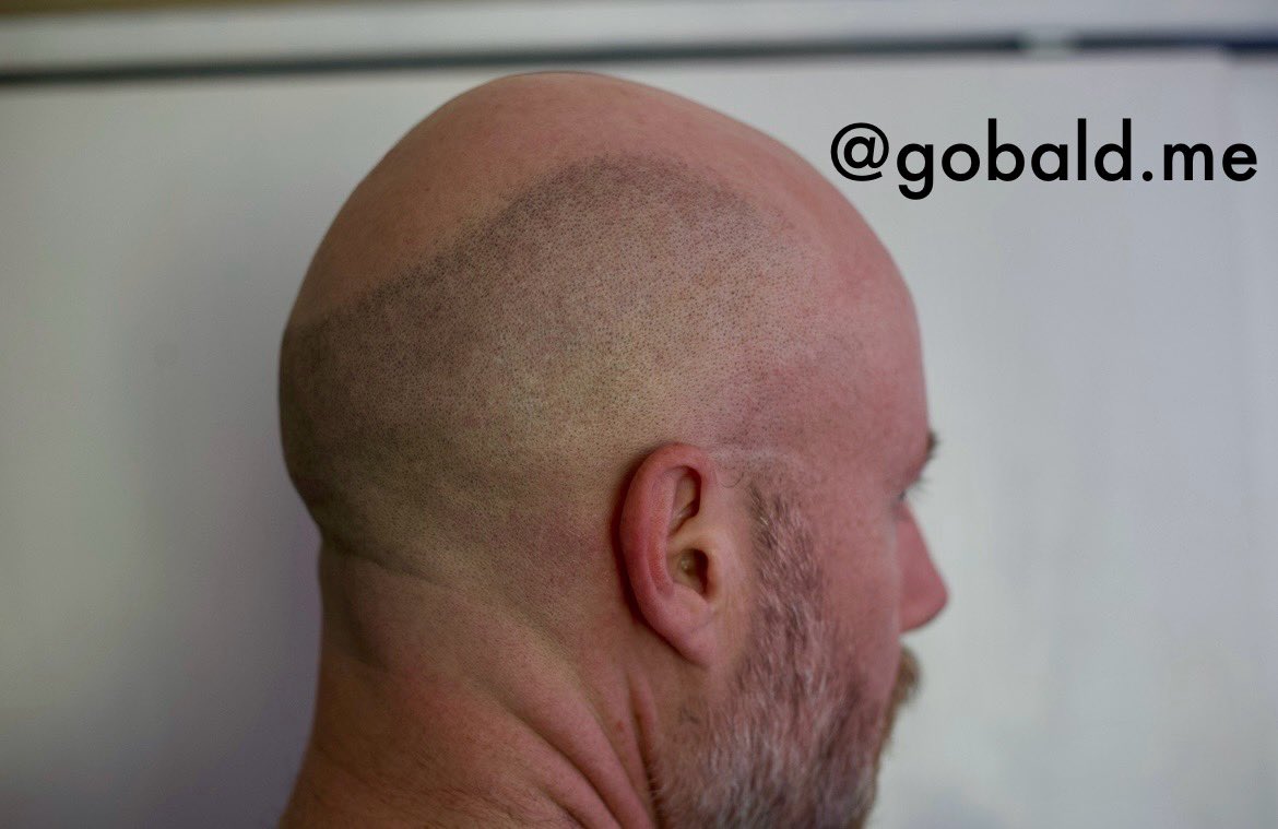 gobalddotme's tweet photo. Got a bit of sun today
#bald #mpb #mpbbc #malepatternbaldbychoice #baldfetish #laserhairremoval https://t.co/iy5EpETqI1