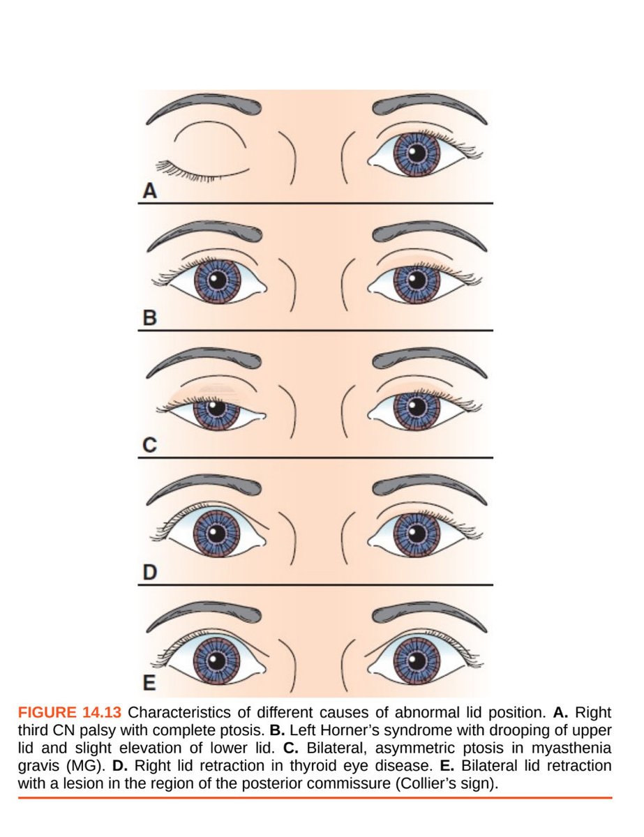 DrMalakbadrani's tweet photo. الفحص السريري (Neuro Clinical Exam) 

أهم اداة عند طبيب الأعصاب حتى أهم من الأشعة (عكس ما يعتقد اغلب الناس) على سبيل المثال كثير من الجلطات الدماغية نعالجها بالمذيب بناءً على الفحص السريري فقط وبالغالب الأشعة بالطوارىء تكون طبيعية وعند إعادة الأشعة بعد ٢٤ ساعة تتضح آثار الجلطة، ايضاً بعض من الأمراض المناعية تبان اعراضها على المريض قبل تغييرات الأشعة، وأمراض الأعصاب الطرفية وغيرها الكثير. 

أفضل طريقة لتعلم الفحص هي اولاً انك تفهم المغزى منه وهذا يحصل بالقراءة، وثانياً انك تمارسه من خلال متابعة فيديوهات، ومراقبة السينيورز والتمرن معاهم، وفحص المرضى بإستمرار. 

مصادر اعتمدتها للقراءة: 

١. DeJong’s: اعتبره أهم مصدر صراحةً، عدد الصفحات مرعب 😙 لكن اغلبها نظري فتجاهلوها وركزو على البارت العملي. (بارت النظري في الCranial Nerves أشوفه رائع) 

يبدأ البارت المهم فيه من تشابتر ١٢، وتجاهلو تشابتر ٢١ إلى ٢٦. 

٢. DeMyer’s: جميل للمراجعة ومختصر، التشابترز المهمة من ٣ إلى ١٢.
