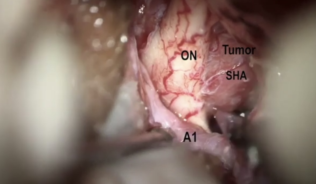 drufukerginoglu's tweet photo. 🧠🎥 New operative video in JNS Reports
Microsurgical resection of diaphragma sellae meningioma with extradural clinoidectomy and preservation of superior hypophyseal arteries.
📄 DOI: 10.1055/a-2765-5582
🔗 https://t.co/Gtg9tceljU
#Neurosurgery #SkullBase  #UWHealth #UWMadison https://t.co/o1HwWpeI2d