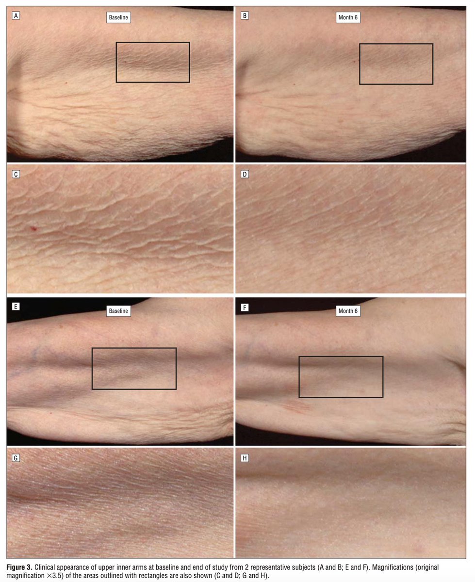 Vitamin A reverses skin aging clinically.

Topical retinol for 6 months:

⇨ Reduces wrinkling
⇨ Improves roughness
⇨ Increases collagen production

Vit A works by controlling gene expression of cells in the skin,

which reduces oxidative stress, inflammation and controls