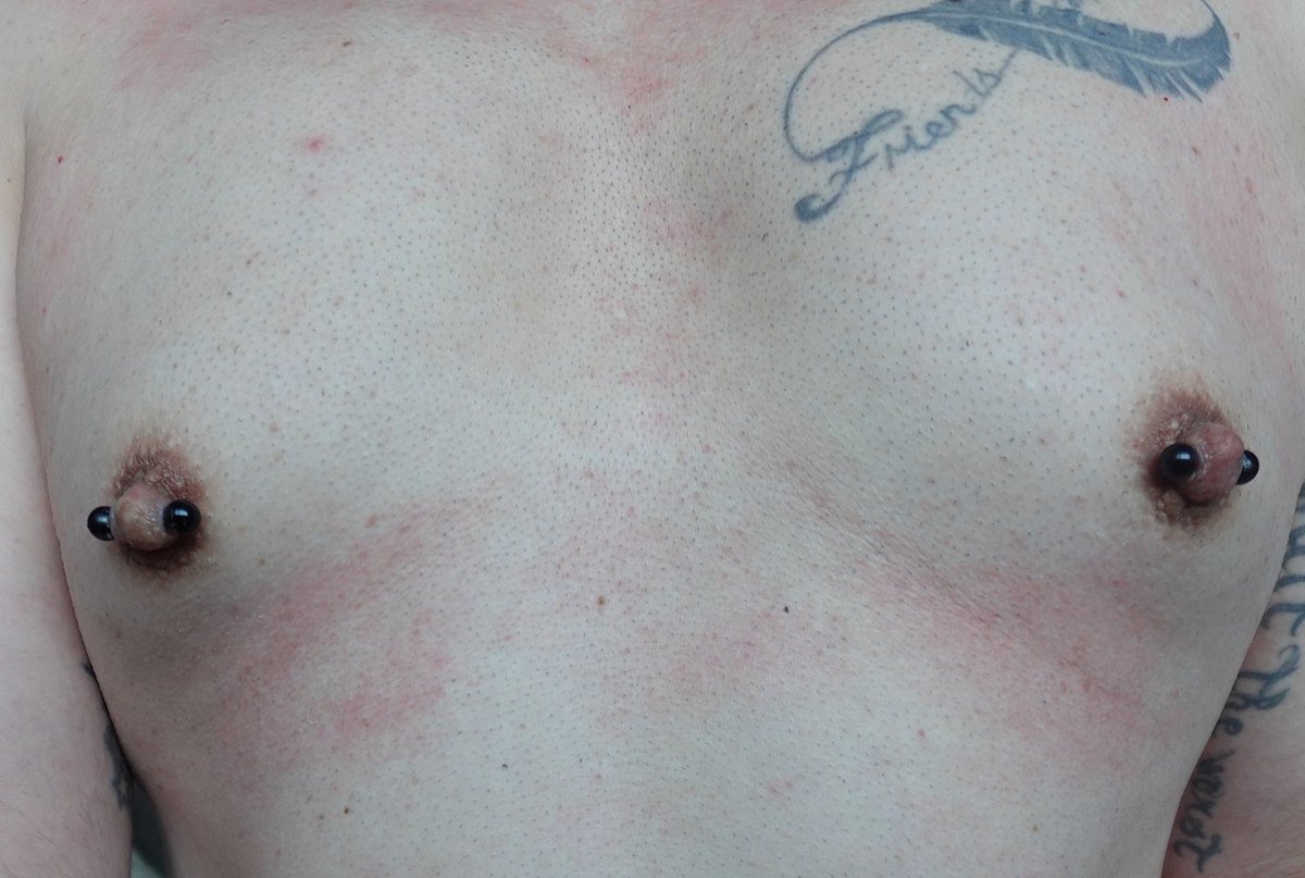 5mm Stäbe durch die Brustwarzen.