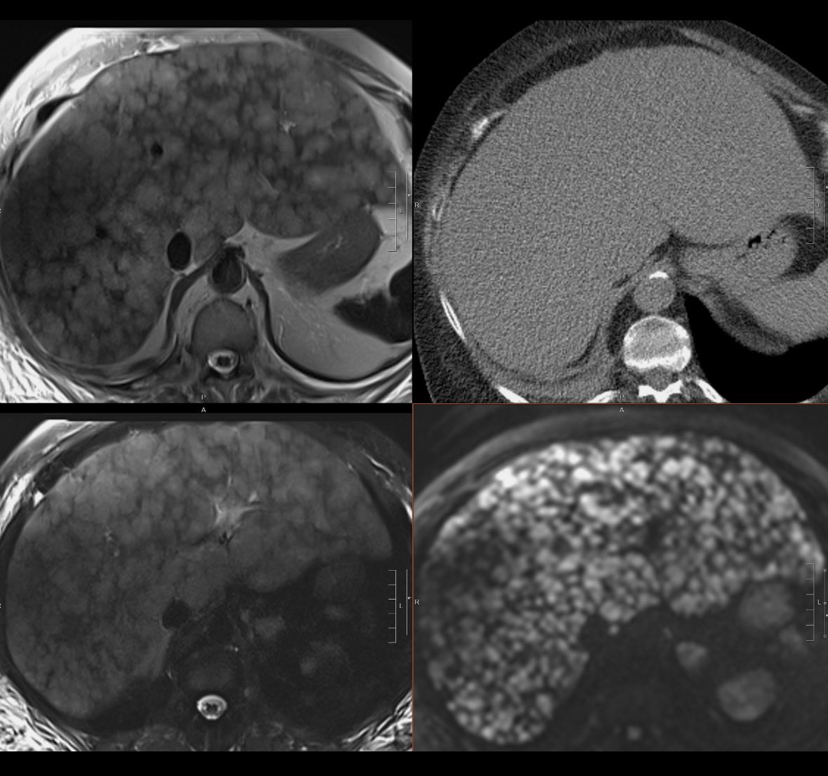WillyRontgen's tweet image. Good reminder that anything can be hiding in the liver on that noncon ER CT. These exams were done on the same day.
