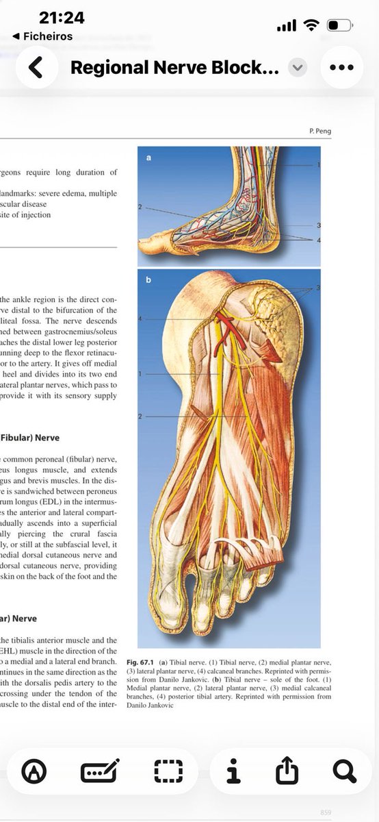 anesthesiadocmd's tweet image. Updated ankle block video 🔗 with Anatomy pearl 🦵 :
There are two tibial arteries (anterior &amp;amp; posterior)…
but only one tibial nerve

youtu.be/2Z6JkHKkAbY?si…