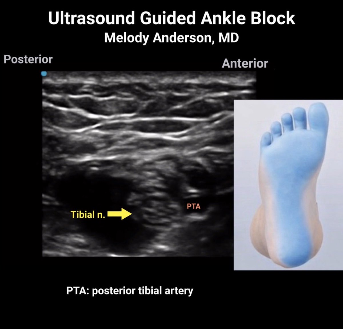 anesthesiadocmd's tweet image. Updated ankle block video 🔗 with Anatomy pearl 🦵 :
There are two tibial arteries (anterior &amp;amp; posterior)…
but only one tibial nerve

youtu.be/2Z6JkHKkAbY?si…