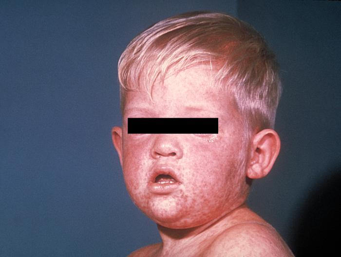 bactiman63's tweet image. #SouthCarolina #measles outbreak top 200 cases   #Spartanburg open.substack.com/pub/outbreakne…