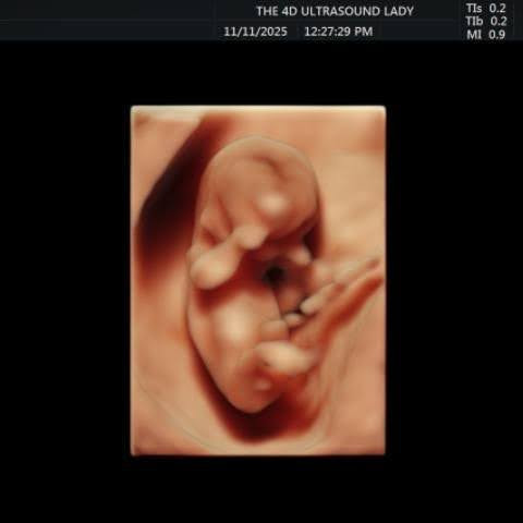 This baby is 11 weeks old.

Planned Parenthood claims the abortion pill just ends a “pregnancy.”

They won’t mention that a precious human being like this one will die, too.