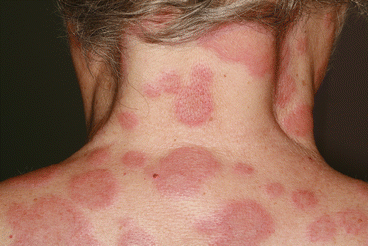 Mayo Clinic Infectious Diseases tweet media