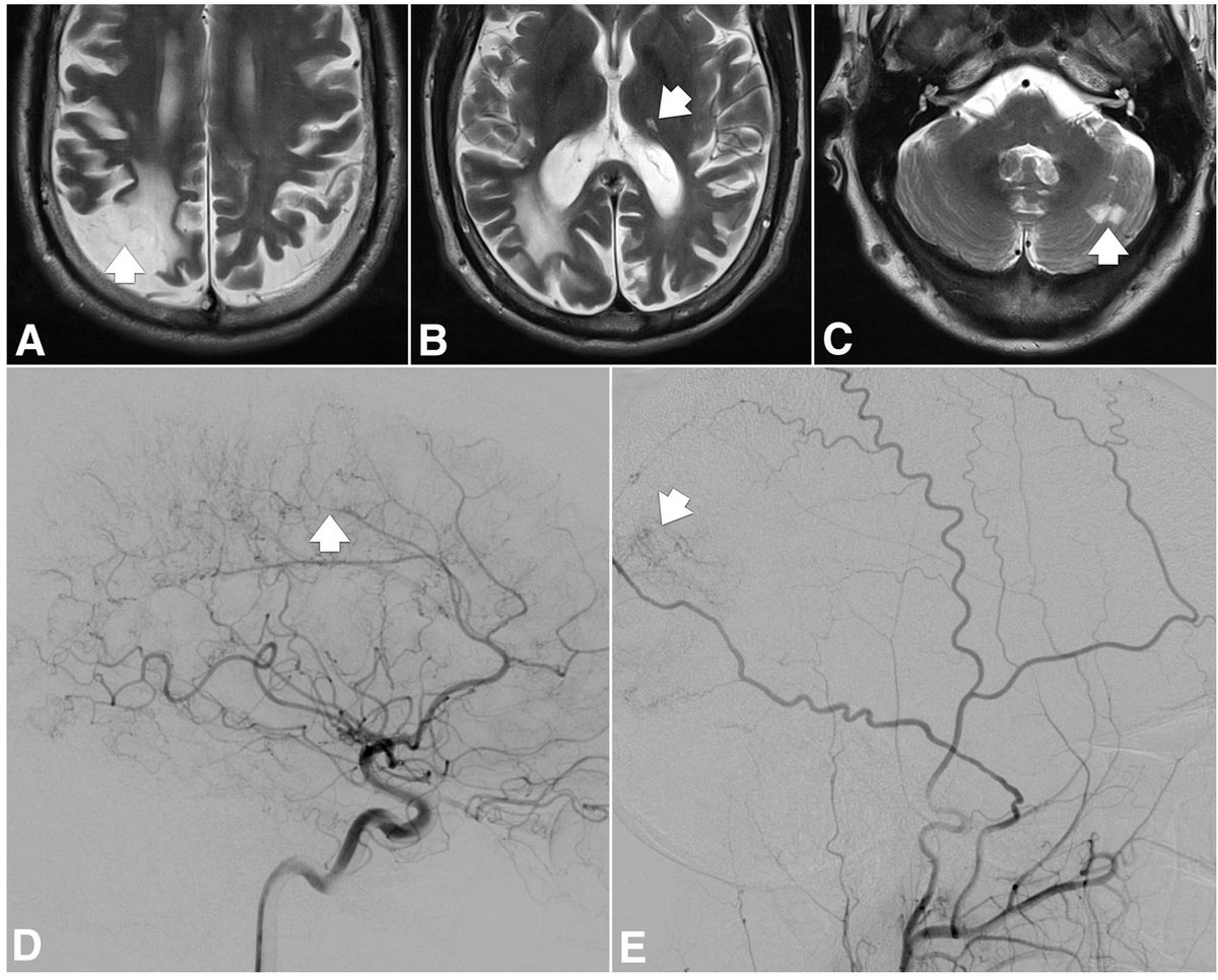 ASNRographics's tweet photo. From the October-December 2025 Issue of #Neurographics: Ten Years of ASNR: Radiopaedia Case of the Day https://t.co/81aSu6yKEu https://t.co/DP7POS0Edz