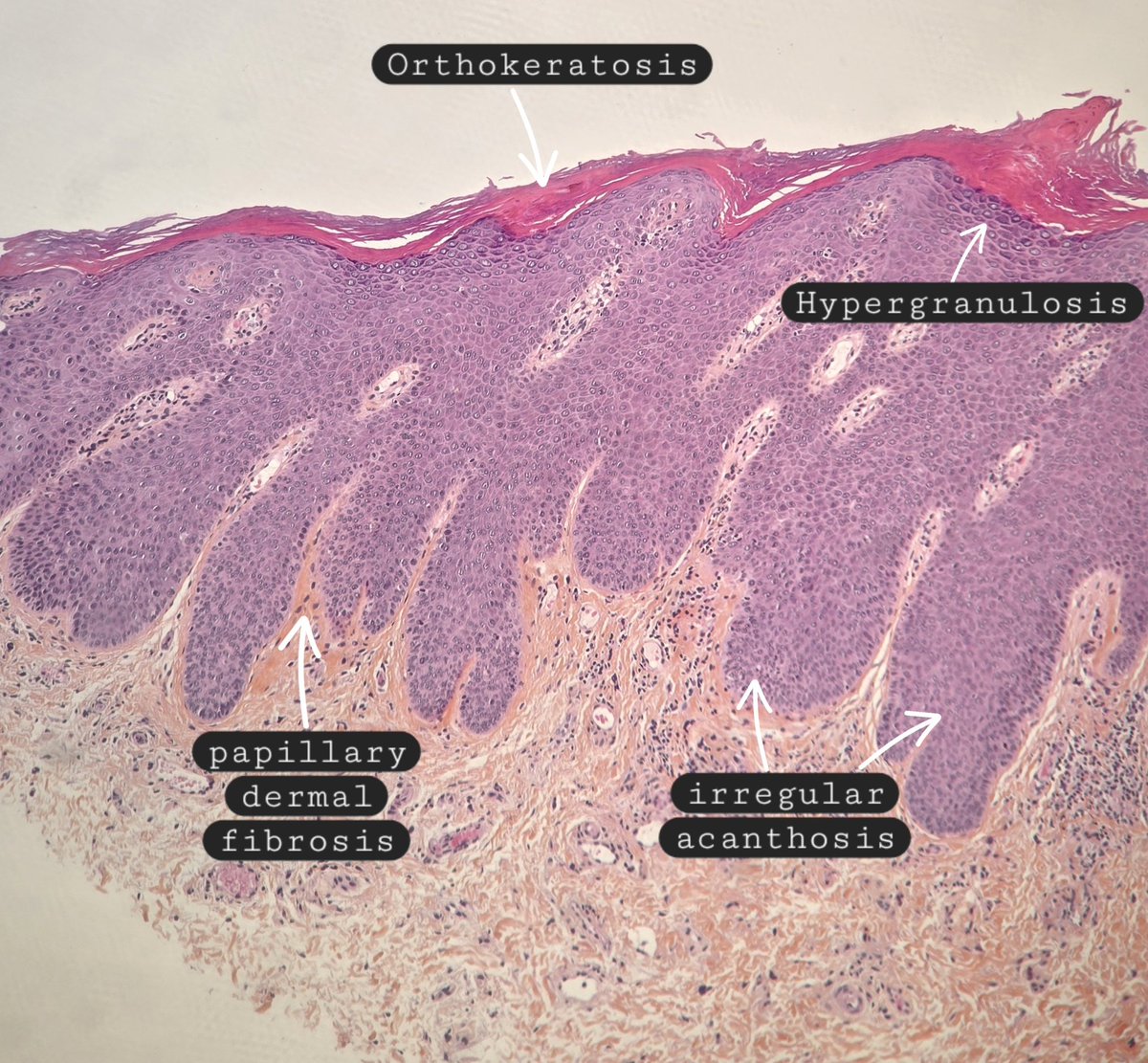 malakbehnas's tweet image. Lichen simplex chronicus 🔬

✔️Chronic dermatitis characterized by localized areas of thickened skin resulting from chronic scratching
✔️Orthokeratosis with focal parakeratosis
✔️Hypergranulosis
✔️irregular acanthosis
✔️Papillary dermal fibrosis

#dermpath #Xpath