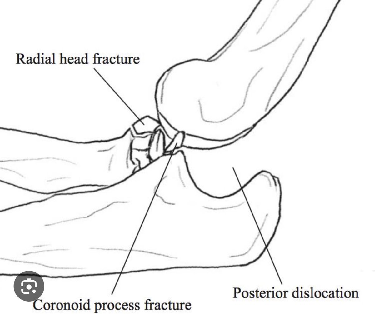 slemanORTHO's tweet photo. Terrible Triad Injury of Elbow https://t.co/rqEOb5Oh7w